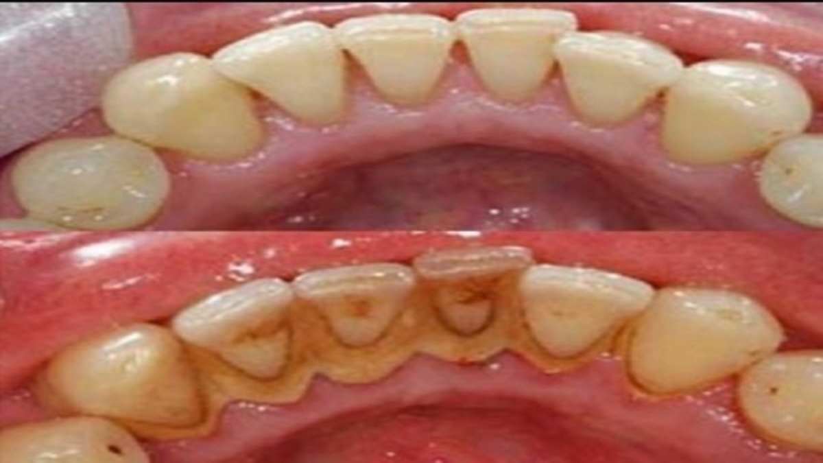 Un Moyen Facile De Se D Barrasser De La Tartre Dentaire Astuces Au